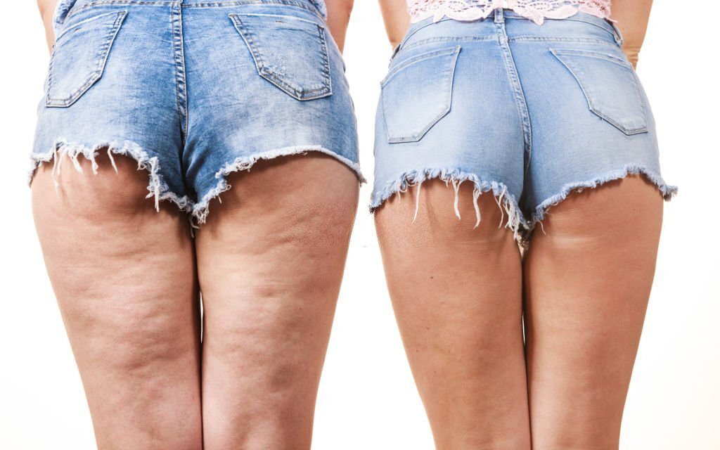 cellulite-fixes-and-treatments